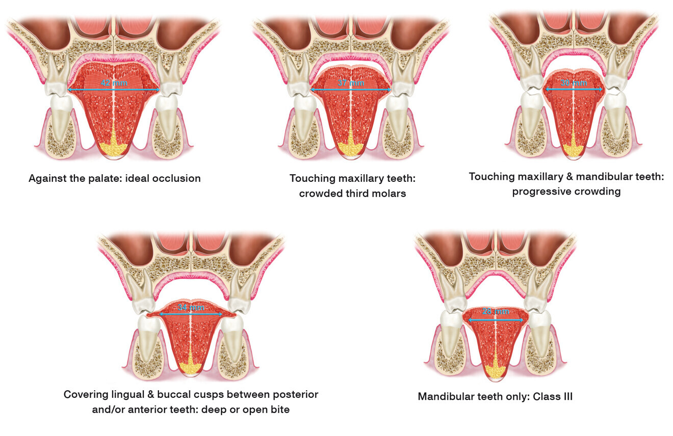 Fig. 6: Mew classification based on tongue positioning.15