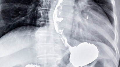 Un test sul respiro per diagnosticare il cancro dell’esofago e dello stomaco