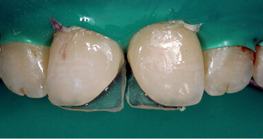 Možnosti individuálního designu pro řezáky aneb každému, co jeho jest…