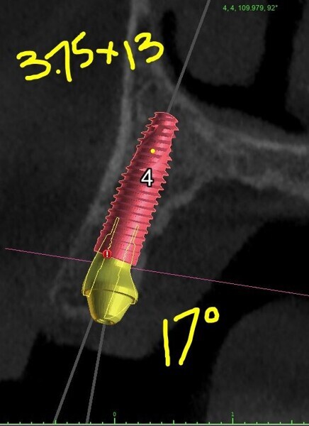 Figs. 4a–f: Cross-sectional planning for maxillary implants and angled multi-unit abutments.