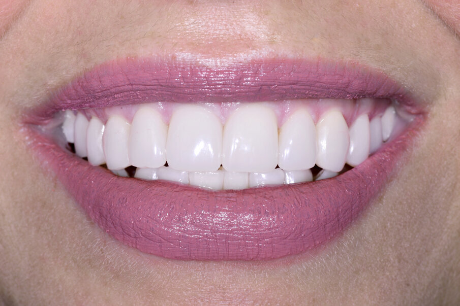 Fig. 10: Overall shade impression when placing the composite shell on the colour strip