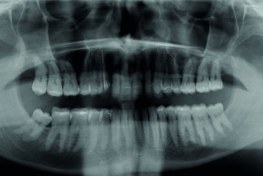 Fig. 15 : Radiographie panoramique à la fin du traitement. 