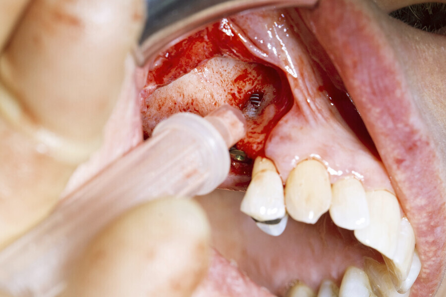 Fig. 6: Use of the BoneTrap to augment the small bone fenestration.