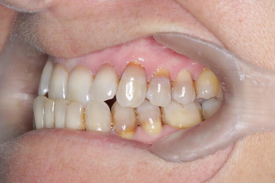 Fig. 26: Initial situation. Class III malocclusion patient.