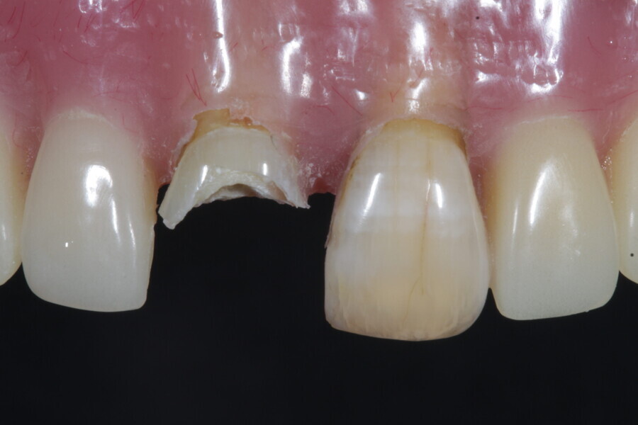 Fig. 3: Endodontically treated fractured tooth #11.