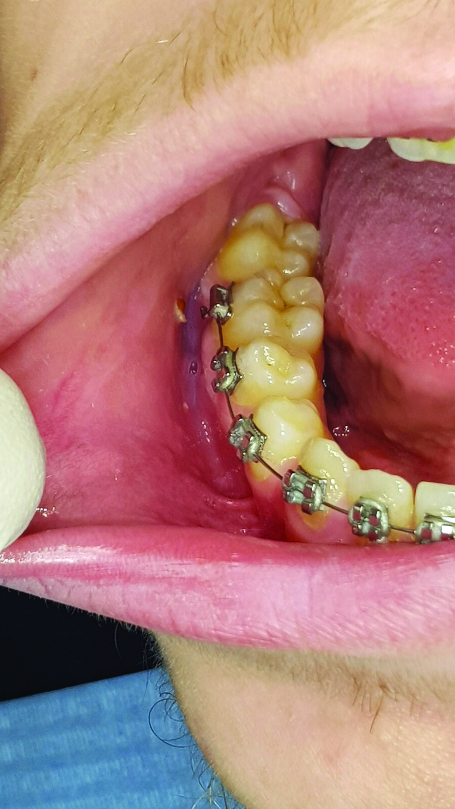 Fig. 4 - La lesione provocata dallo strofinamento della mucosa buccale con i bracket in corrispondenza degli elementi 43-44-45 è completamente regredita dopo 5 giorni di trattamento.