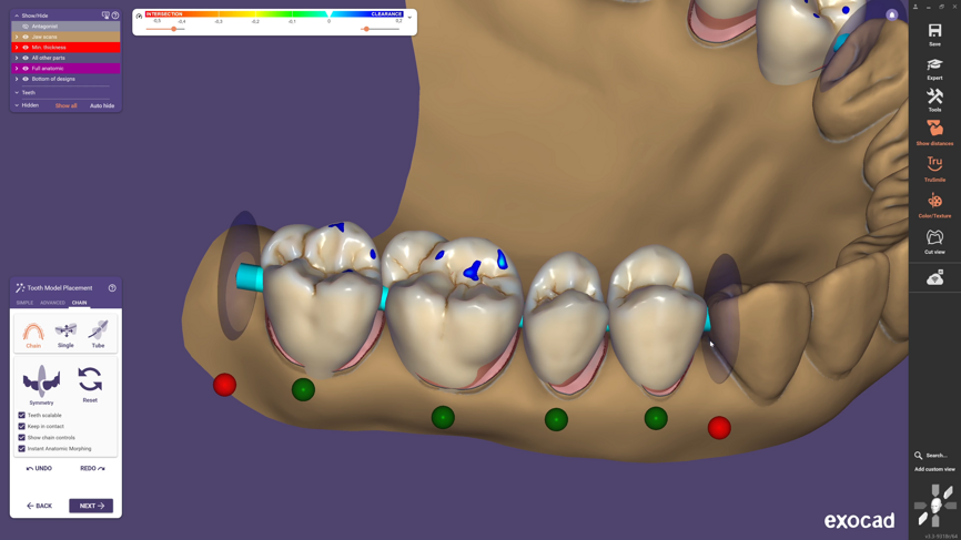 Instant Anatomic Morphing for efficient multi-tooth adjustments.