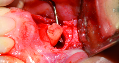 Supernumerary teeth: Diagnosis and treatment