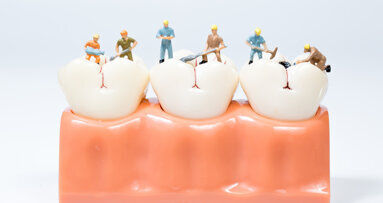 Largest study to date on dental caries experience in Norwegian adult population