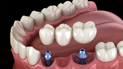 Neue S3-Leitlinie „Ersatz fehlender Zähne mit Verbundbrücken“ Neue S3-Leitlinie „Ersatz fehlender Zähne mit Verbundbrücken“