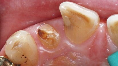 Keramické implantáty: Včera vize, dnes reálná výzva?