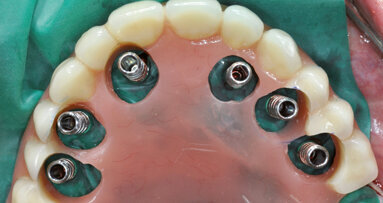 Restauro immediato su impianti nel mascellare edentulo
