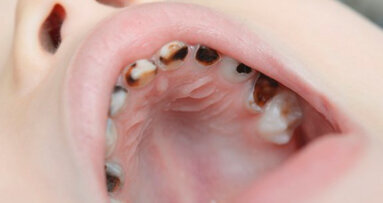 Il rischio di carie potrebbe non attenuarsi nemmeno a seguito di cure preventive