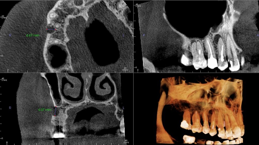 Dane CBCT mogą pomóc w stworzeniu zindywidualizowanych modeli 3D stosowanych do regeneracji tkanki przyzębia
