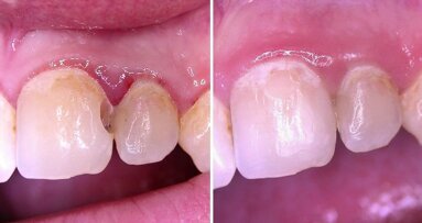 Webinar: Flexible Response in der Parodontaltherapie