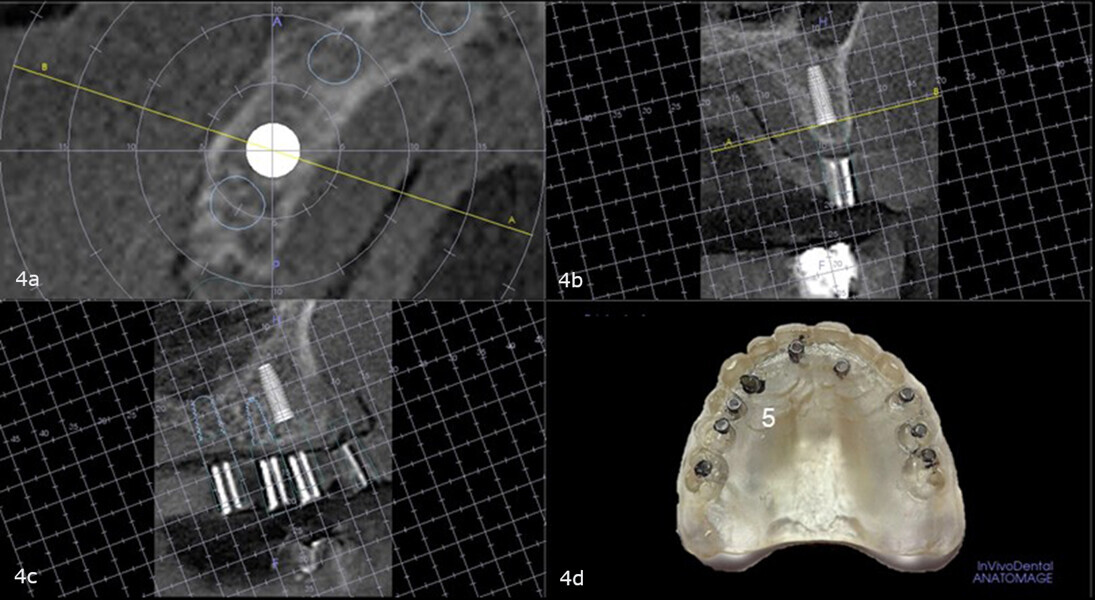 Figs. 4a–d: Virtual planning with the diagnostic guide placed intra-orally during the CBCT scan showing sufficient bone to accommodate a fixation screw in the maxillary right first premolar site and no need for angular or linear correction (a–c). Site on the duplicate denture (d).