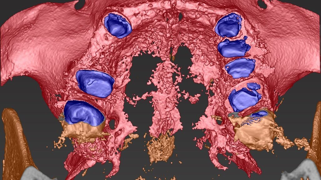 Piano di trattamento clinico con utilizzo di progetto digitale complesso su edentulie estese di entrambe le arcate dentarie