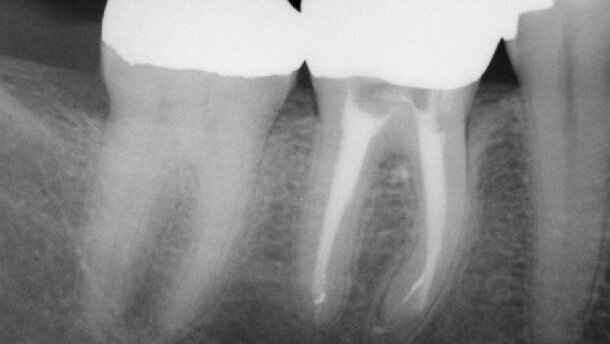 Điều Trị Nội Nha Lại: Đạt Tới Thành Công Trong Lần Điều Trị Thứ Hai