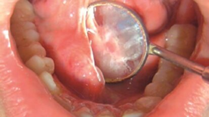 Leczenie zachowawcze dużych kamieni gruczołów ślinowych w śliniance podżuchwowej