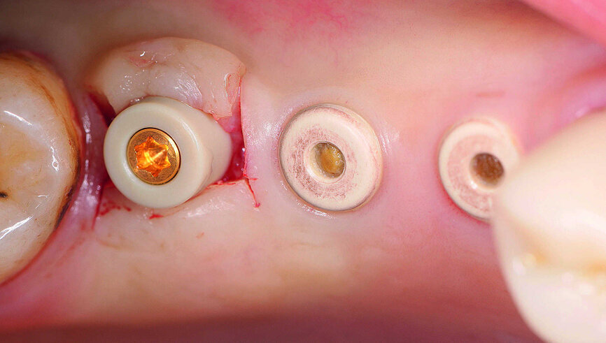 Fig. 18 : Chirurgie de désenfouissement six mois après l’intervention.