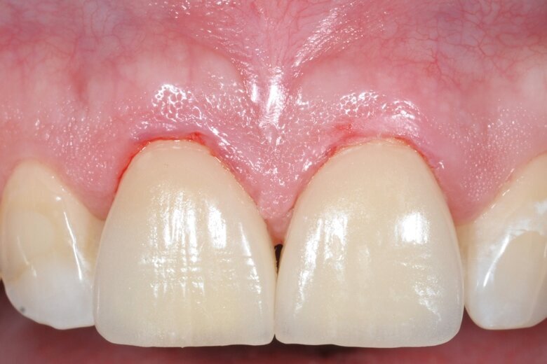 Fig. 25 Immediately post-op.