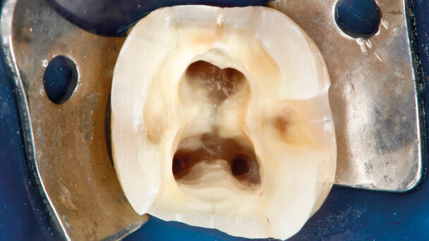 PIPS: un approccio biomimetico all’anatomia endodontica
