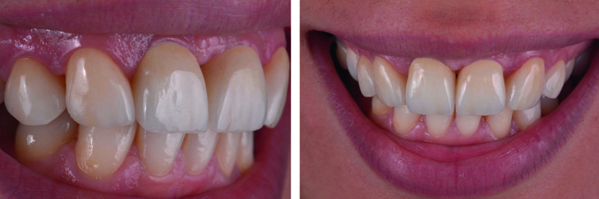 Figs. 33–34 : Résultat final.