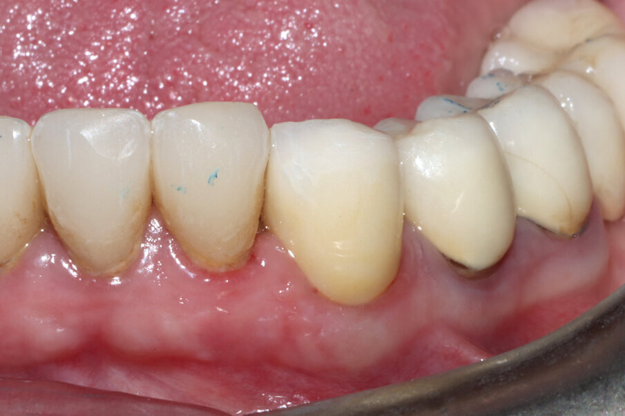 Figg. 18, 19_Visione laterale dei tessuti guariti e alla consegna della corona; si noti la presenza delle papille.