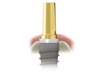 PERIOSAFE & IMPLANTSAFE