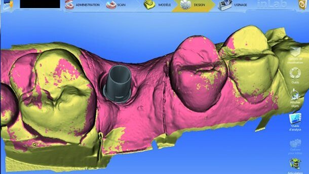 Cas clinique de couronnes sur piliers implantaires CFAO