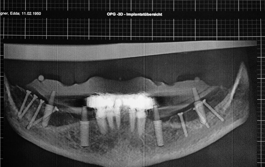 Fig. 4 : Tomographie panoramique dentaire virtuelle montrant les positions des implants définies numériquement en 3D. 