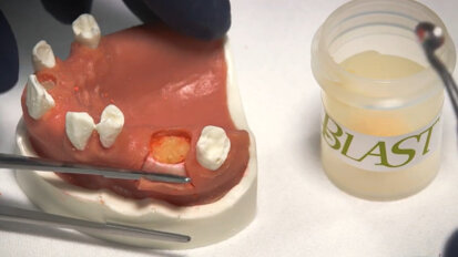 Keystone Dental Group – DynaBlast Putty