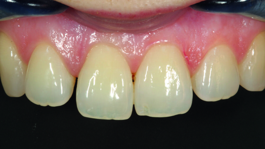 Afbeelding 1. Beginsituatie: opening tussen de middelste en laterale rechter snijtand.