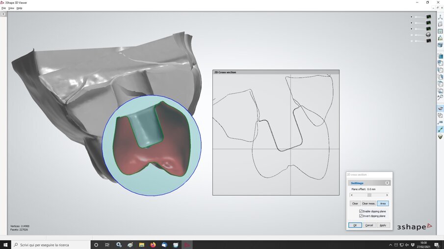 Fig. 11_L’analisi ricostruttiva prosegue con software di progettazione molto sofisticati. In questa immagine affiora il volume protesico in sezione valutando l’interfaccia coi tessuti limitrofi.
