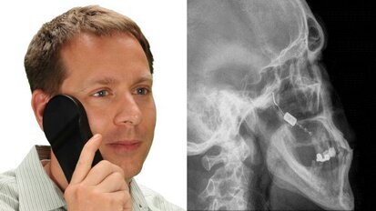 Neurostimulacija: Gingivalni implantat pomaže smanjenju cluster glavobolje