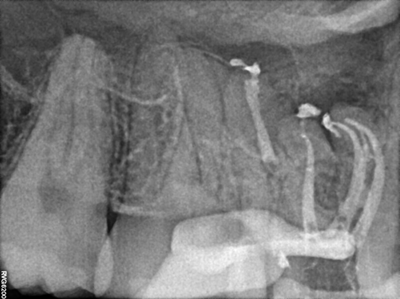Fig. 46: Post-op radiograph, distal shift, showing one isthmus in the coronal part and the second in the apical part.
