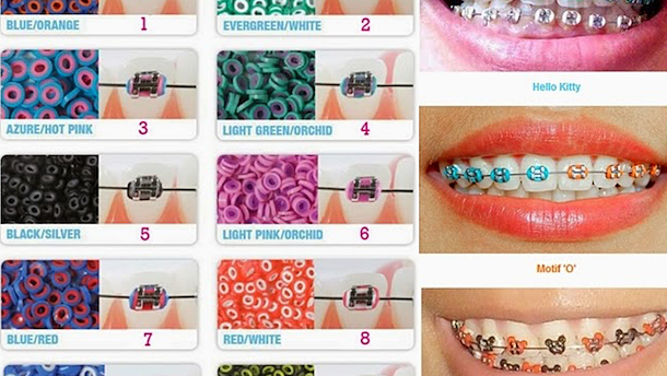 La irresistible moda de los brackets