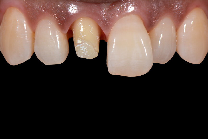 Fig. 1, Antes: Preparación de corona completa en el diente 11 tras endodoncia.