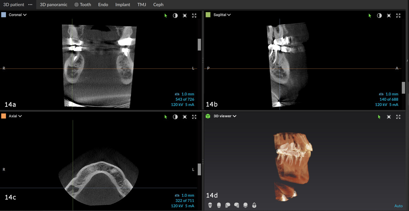 Figs. 14a–d: Bone lesion with a non-uniform border or shape on the CBCT scan.