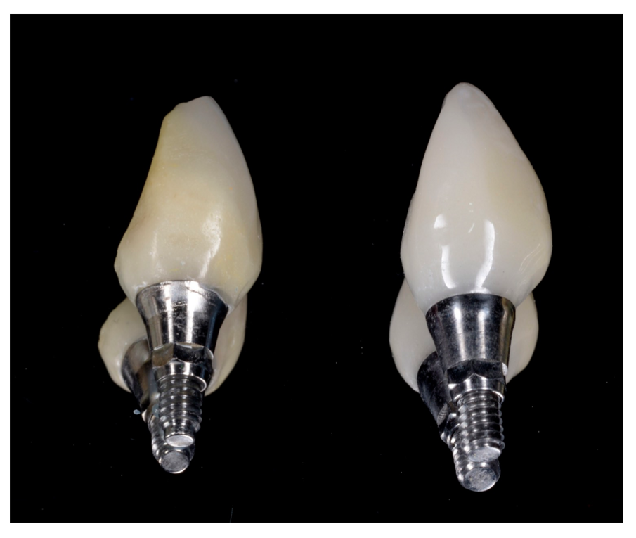 Fig. 14_Profilo di emergenza del provvisorio (a) replicato nel definitivo (b).
