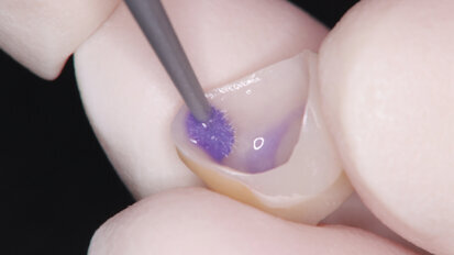 The importance of dental cleaners