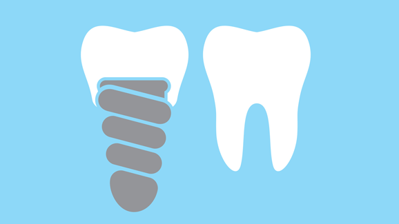 Englische Broschüre erklärt Zahnpflege für Implantate
