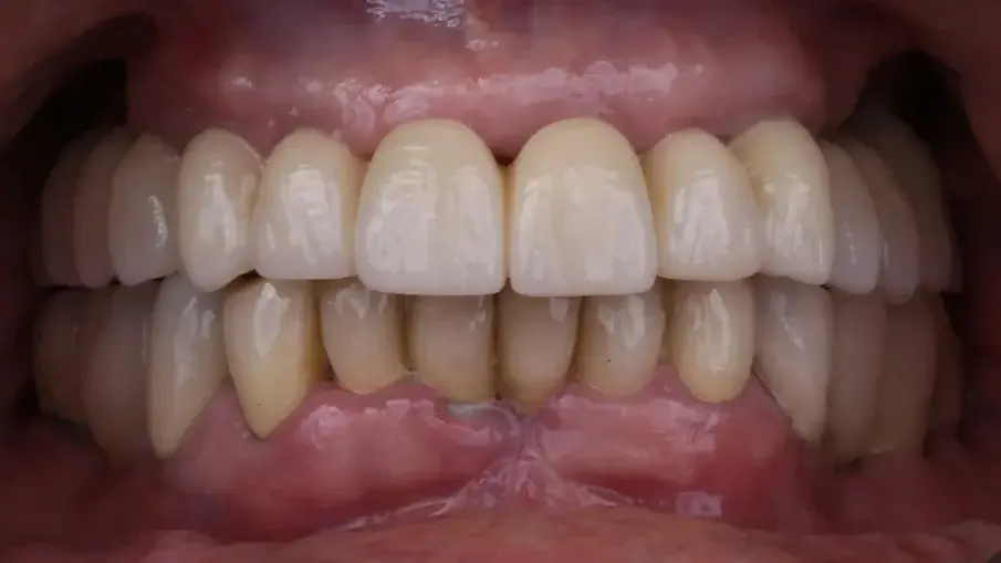 Фиг. 19: Окончателна протеза при едногодишното проследяване, фронтален изглед.