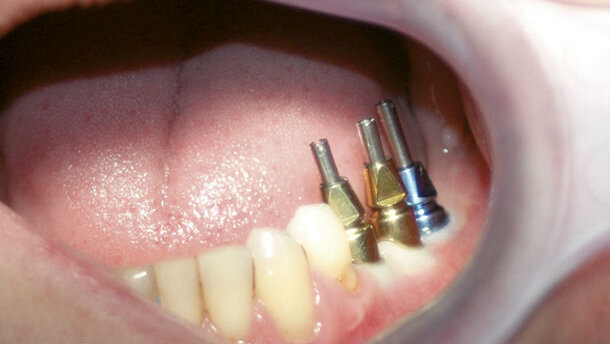 Impianti + Impronte ≠ Complicanze