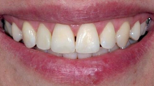 Zmiana kształtu siekacza bocznego za pomocą licówki kompozytowej wykonanej metodą bezpośrednią