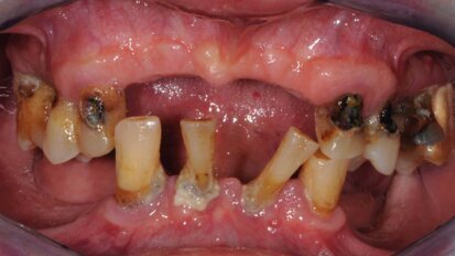 Impianti extra-corti e carico  immediato: un case-report