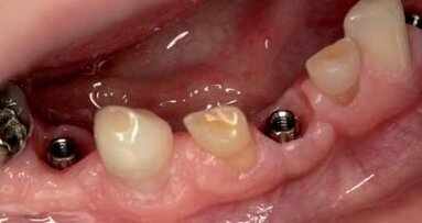 Kompromisowe leczenie implantoprotetyczne i zachowawcze w przebiegu dysplazji ektodermalnej