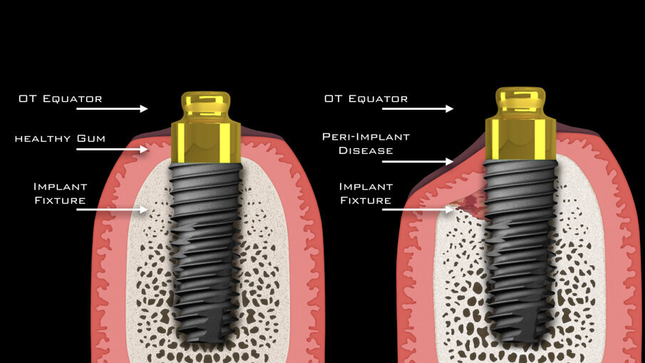Fig. 21_Schema di progressione delle patologie peri-implantari.