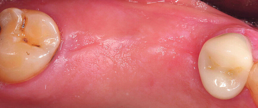 Figs. 1 et 2 : Situation intra-orale initiale. 