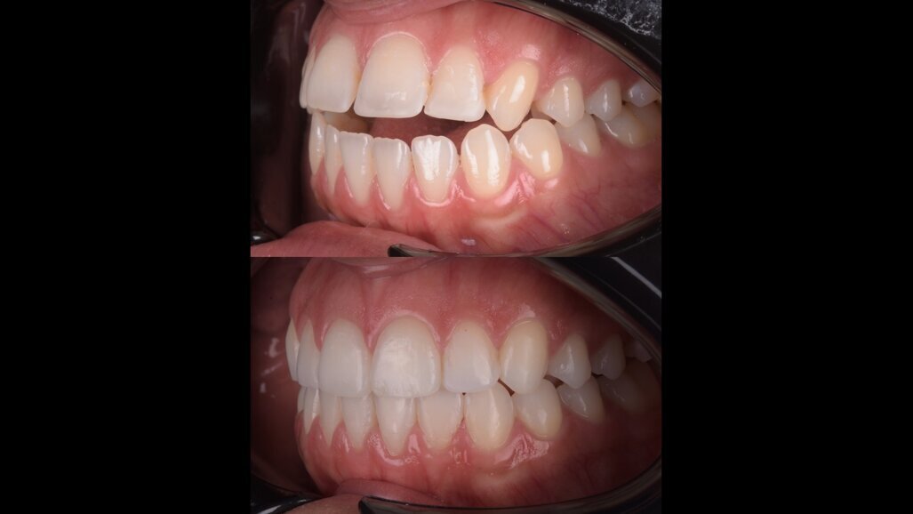 Treating a complex anterior open bite